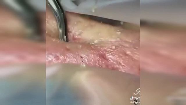 Подборка выдавливания прыщей II выдавливание прыща