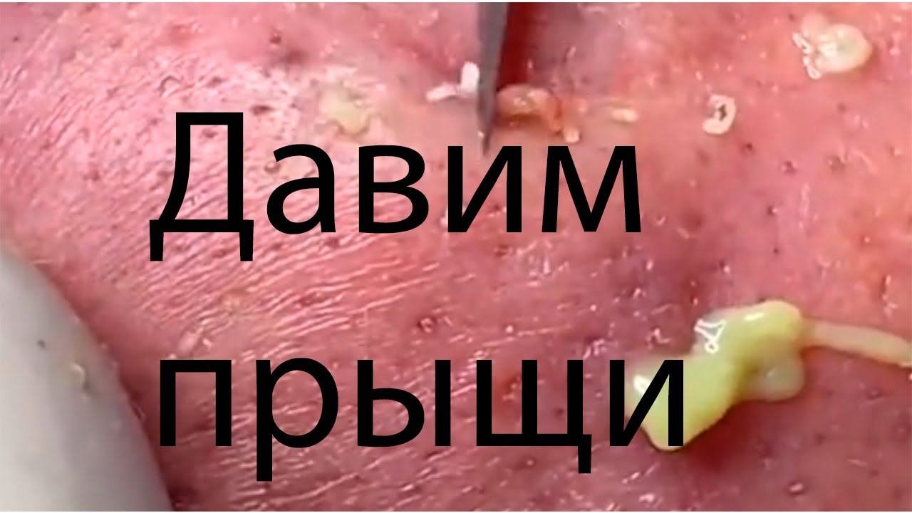 Мега огромная подборка удаления прыщей, чёрных точек, угрей. #22