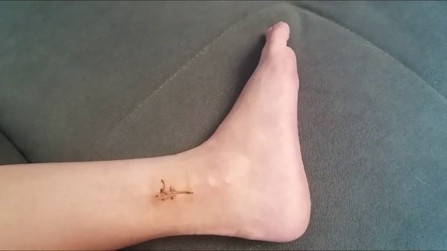 Двухлодыжечный перелом со смещением. УДАЛЕНИЕ ПОЗИЦИОННОГО ВИНТА.