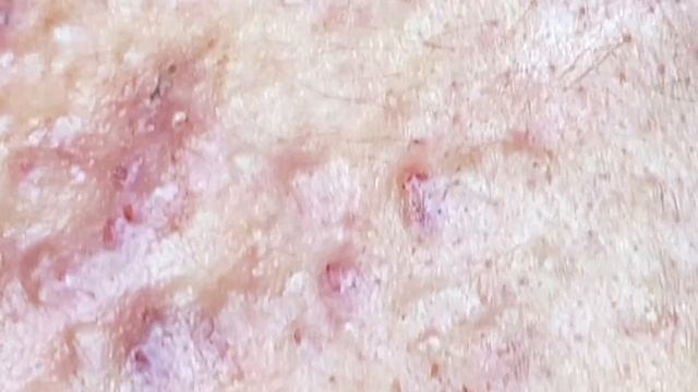 Best Pimple Popping P2 | Mụn Dậy Thì Siêu Hấp Dẫn P2 - SacDepSpa#182