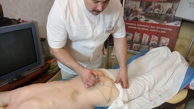 Как разблокировать седалищный нерв, снять ишиалгию, ущемление и синдром грушевидной мышцы?