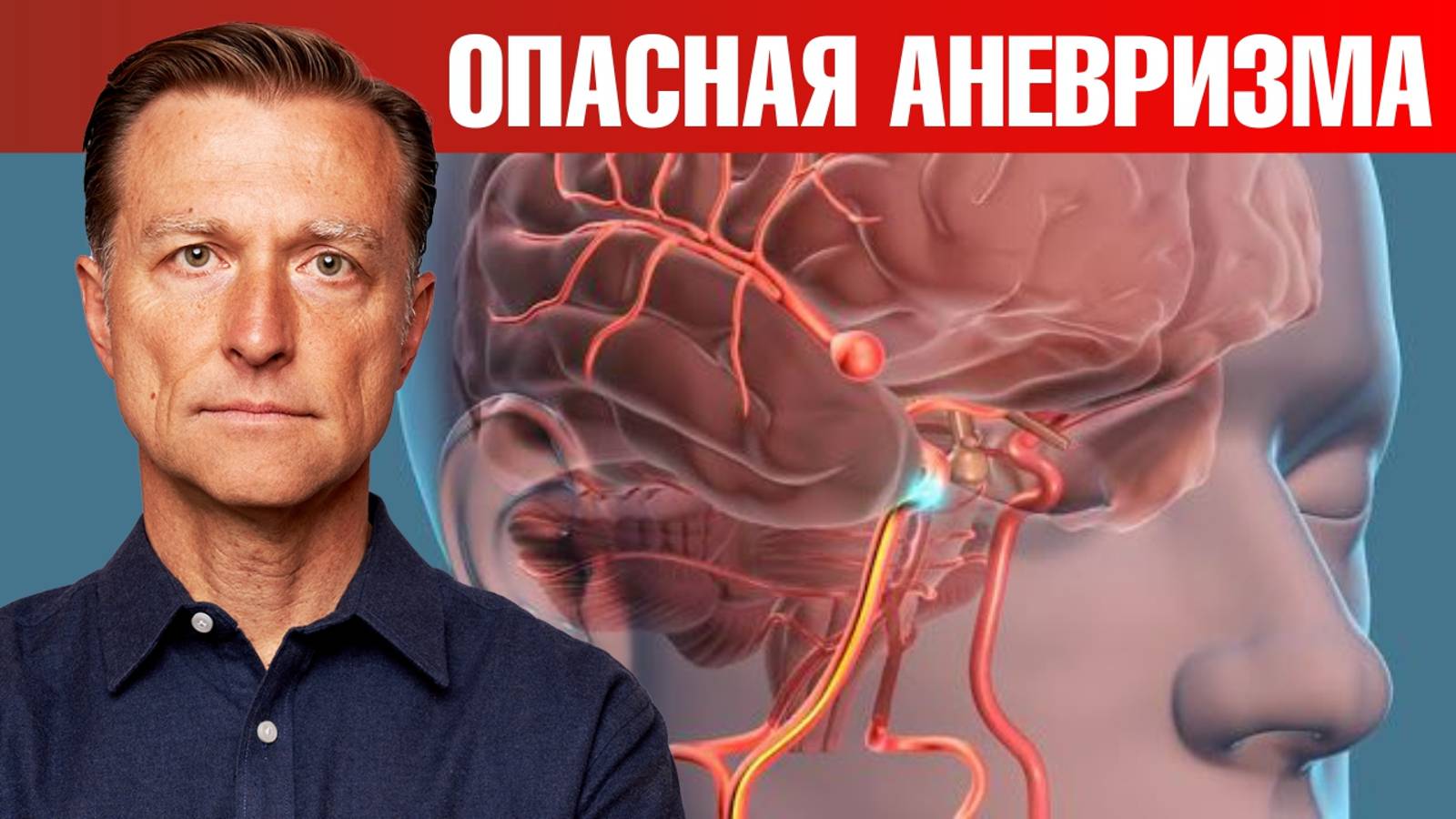 Боитесь инсульта? Бойтесь АНЕВРИЗМЫ. ☠ Причины аневризмы.