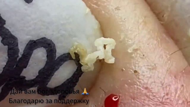 ЧЕРНЫЕ ТОЧКИ? ВЫДАВЛИВАНИЕ. УХОД ЗА ЛИЦОМ