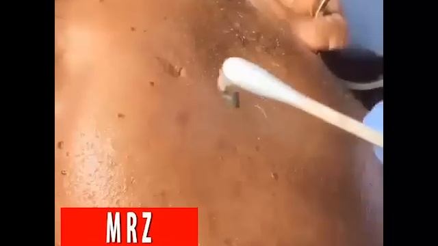 мерзкое видео/ выдавливание прыщей/ выдергивание зубов/ гной 2017 #1