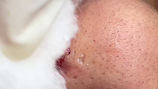Very Rare Blackheads Flower Pattern ? - Linh My Dang