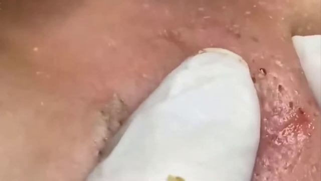 Remoção de cravo 2021 - Pimple Popping 2021 -Blackhead Removal EP0018