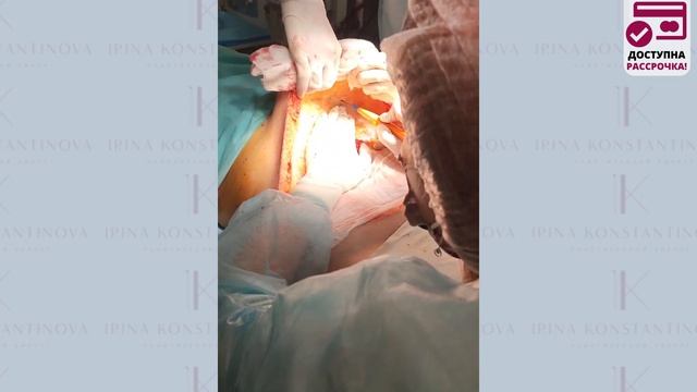 Абдоминопластика - пластика живота. Съемка с операционного стола. Хирург Константинова Ирина