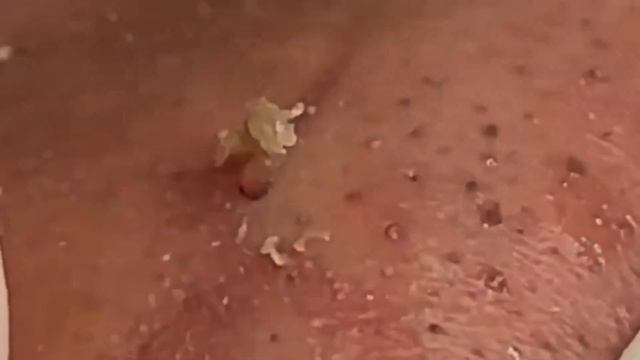 Выдавливание черных точек и прыщей