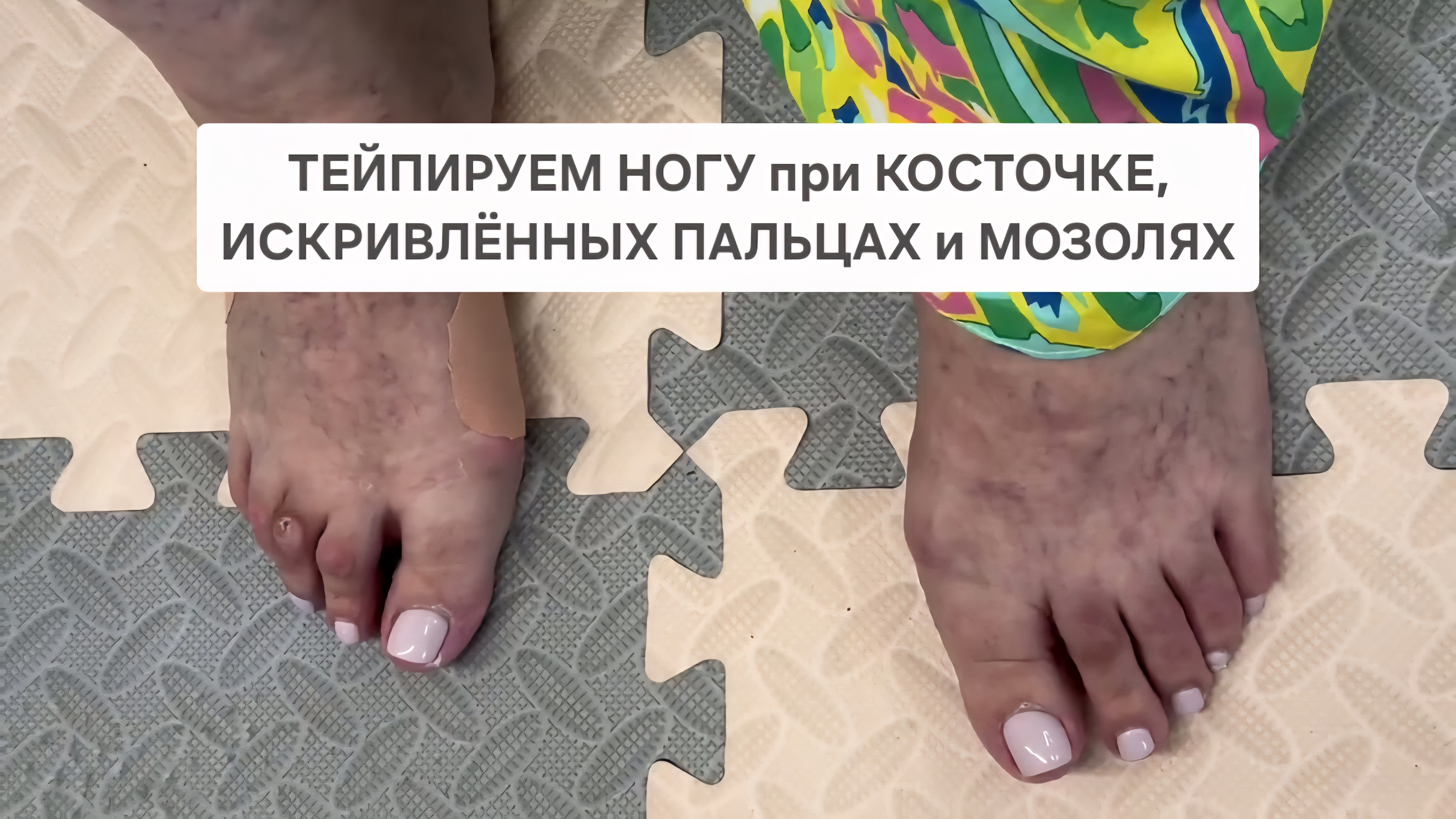 Тейпируем ногу при косточке, искривлённых пальцах и мозолях на них