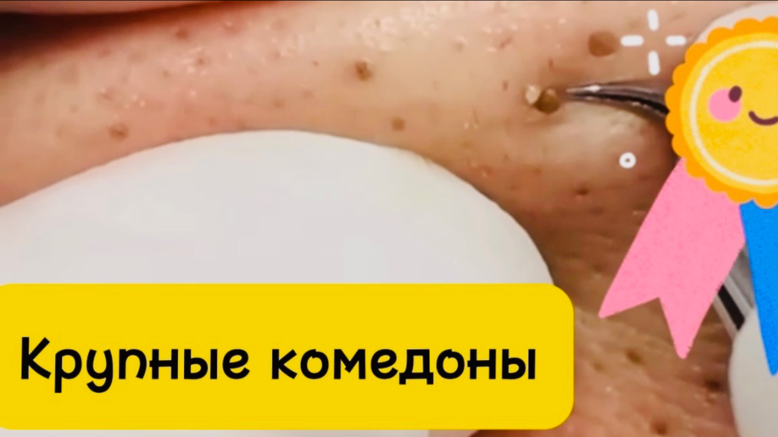Чистка лица от угрей и акне. Выдавливание прыщей. Удаление черных точек и комедонов
