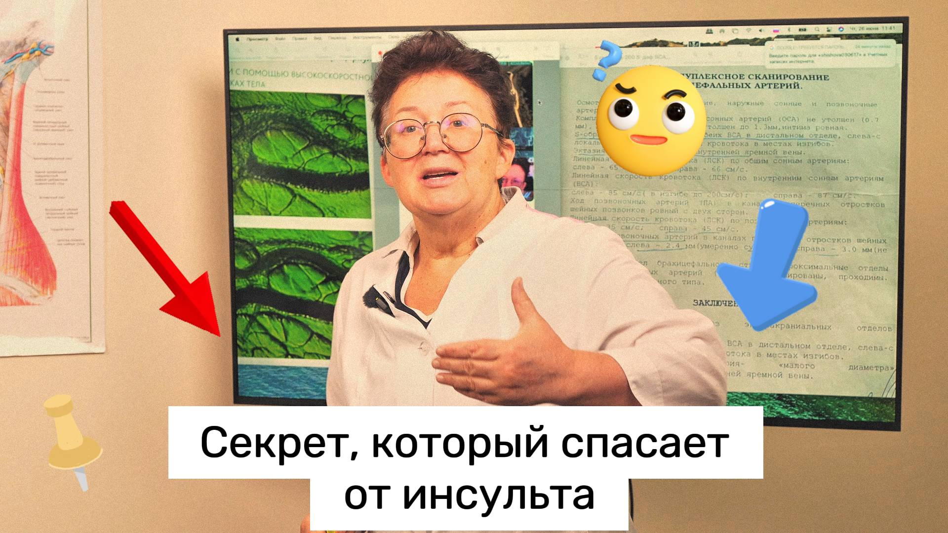 Как избежать инсульта?