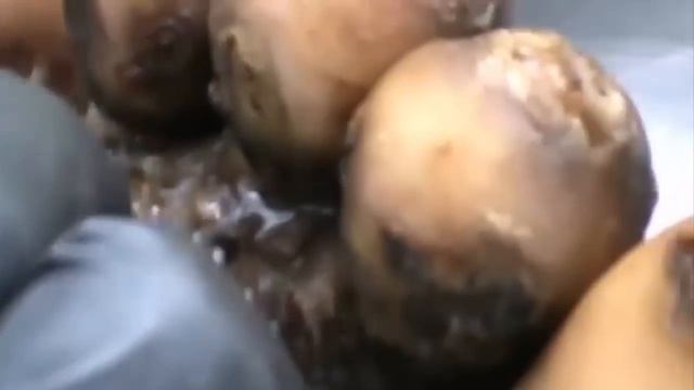 How to remove a jigger from the foot - วิธีการลบ Jigger จาก เท้า P1