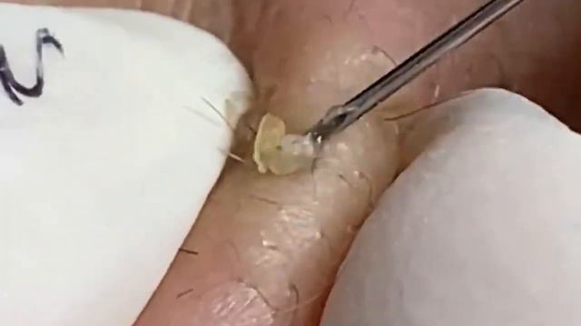 pimple,popper,extraction,blackhead,whitehead,milia,asmr,cyst