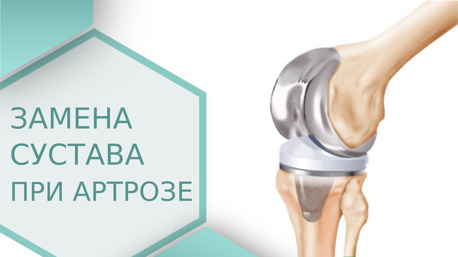 ? Тотальное эндопротезирование коленного сустава при артрозе. Замена сустава при артрозе. 18+