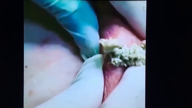 Подборка гнойных прыщей! Pimples! Acne!