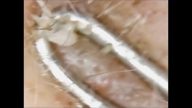 Выдавливание черных точек под микроскопом часть 3
