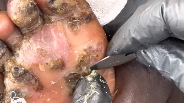 Dejiggering Samson the crybaby's HEAVY JIGGERS - - to watch full video @riseupsociety.net