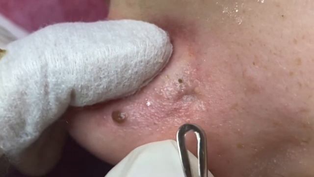 粉刺 粟粒腫 Самое залипательное видео давить прыщи Черные точки Dermatologist video to press pimples