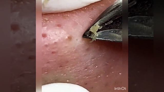 How to remove black head on nose#acne treatment