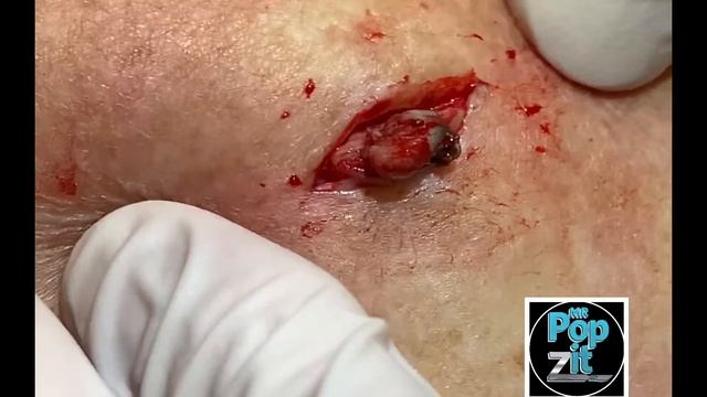 Double barrel blackheads Dilated pores of winer. Blackhead pop. Big squeeze. Cyst excision. Cyst po