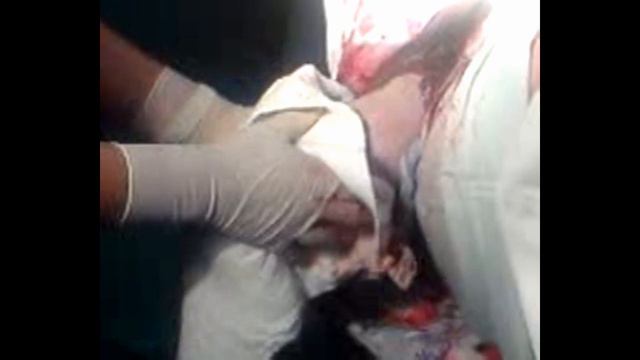 PARTO PODALICO(Vladimir Palma) Gineco-Obstetra