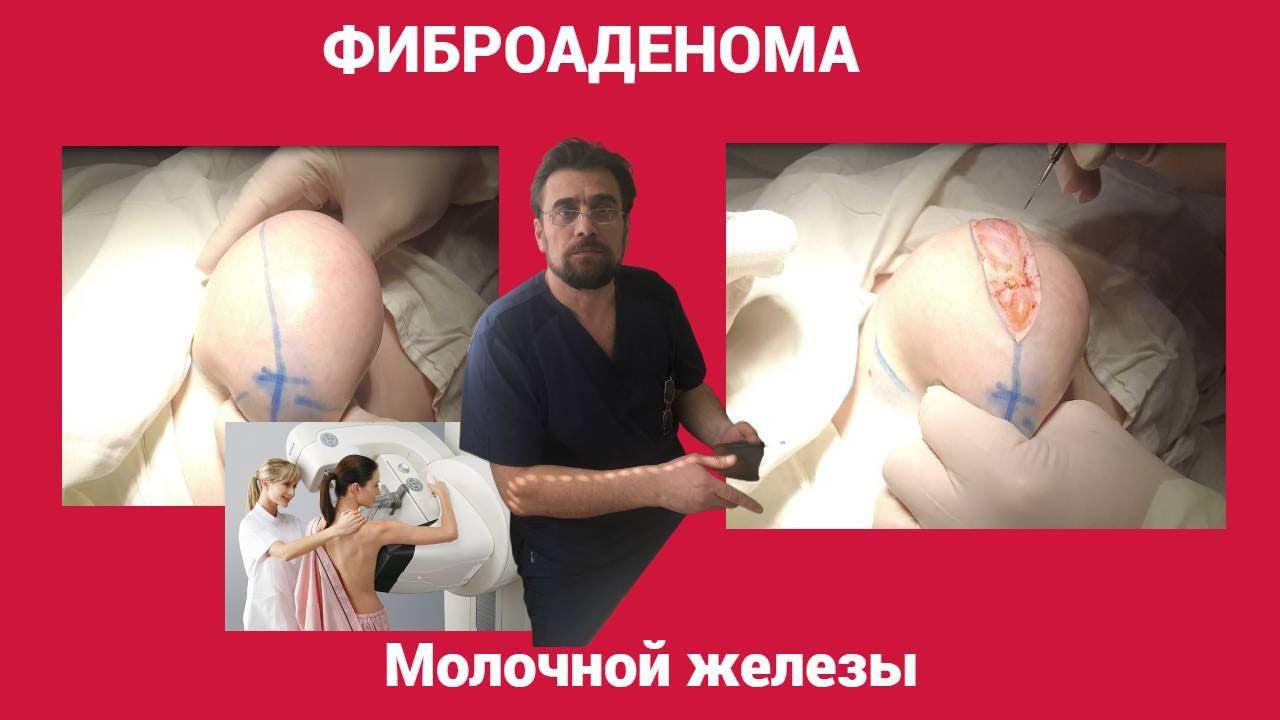 Фиброаденома молочной железы.