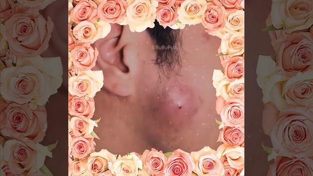 Гнойник на лице