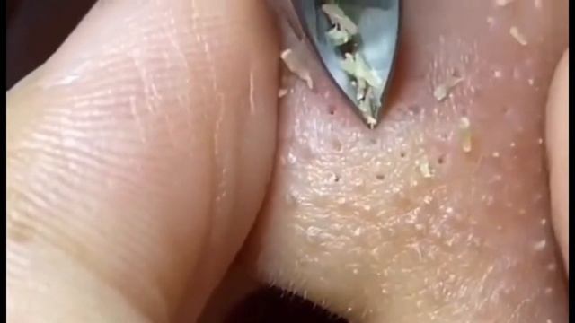 Выдавливание мерзких чёрных точек угри ПРЫЩИ / BLACKHEADS