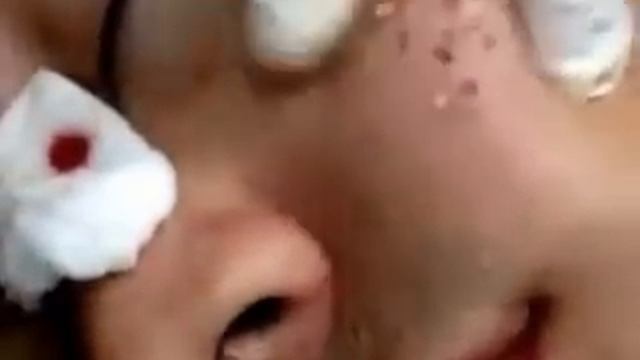 Как удалить угри на лице