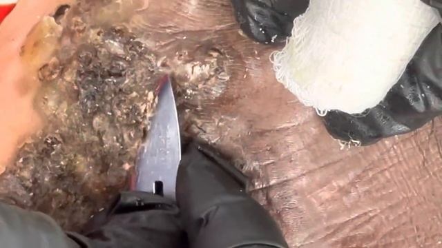 Moses’s right foot part B - subscribe @riseupsociety.net for full juicy JIGGER videos