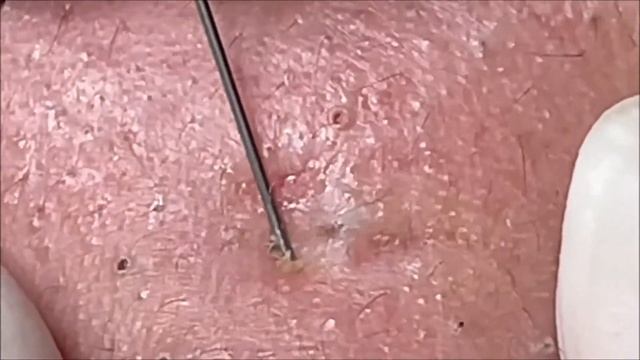 Relaxing Acne Treatment Acnes Treatment 133